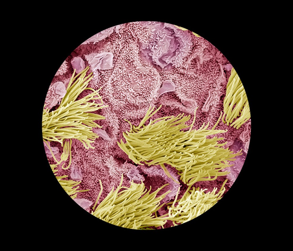 Micrografia eletrônica de varredura colorida de câncer  no útero — Foto: : Getty Images