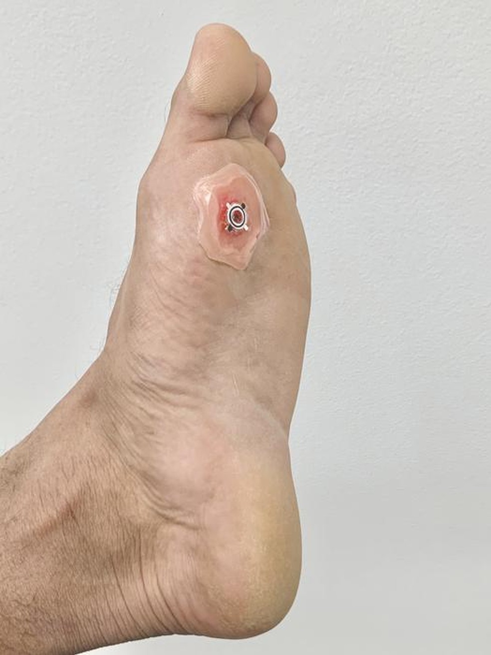 O curativo é flexível e se adapta à superfície das feridas crônicas, que podem ser profundas e irregulares — Foto: Rajaram Kaveti