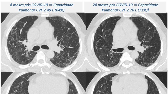 Sequela pulmonar pode piorar dois anos após a internação por Covid-19 grave