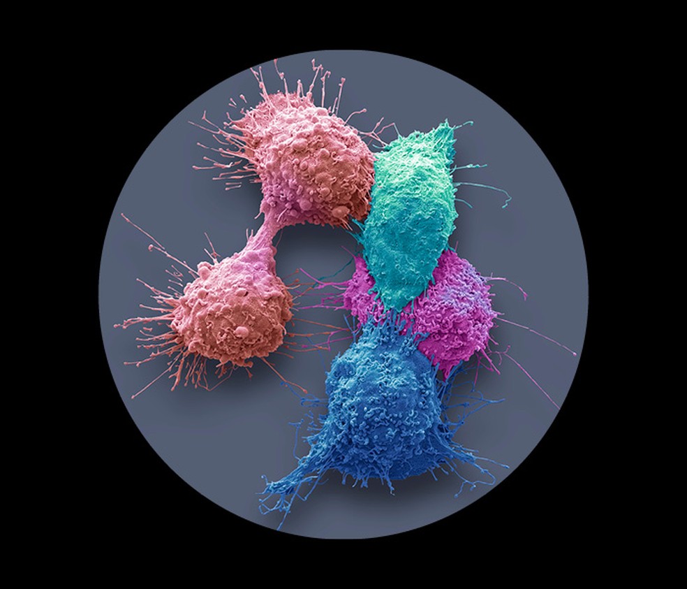 Células de câncer de ovário, que costuma ser diagnosticado tardiamente — Foto: Getty Images