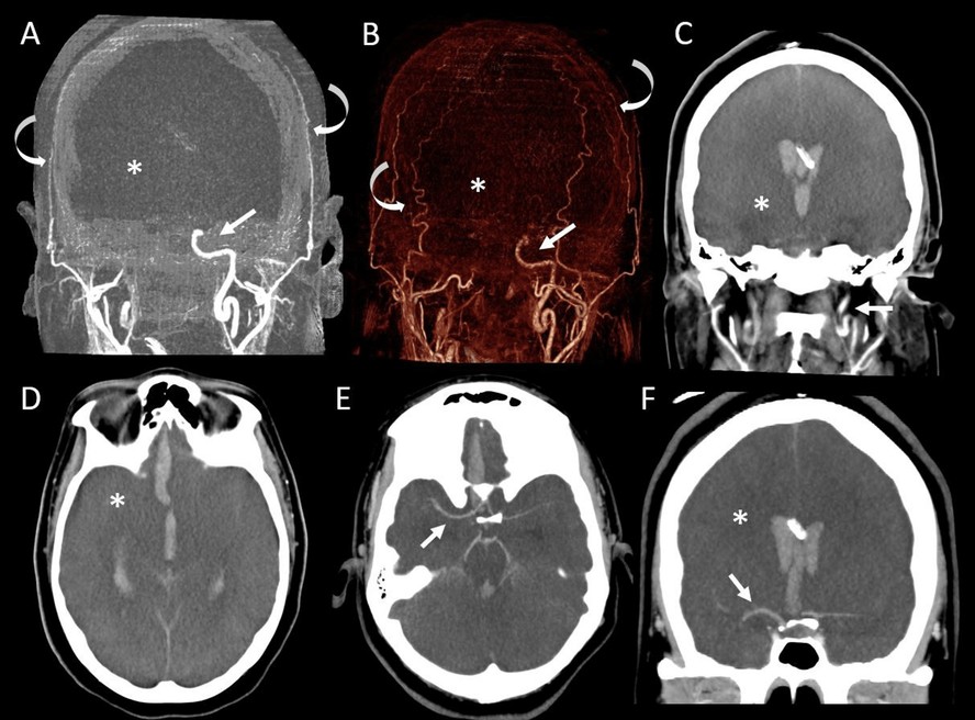 Tomografia computadorizada da fase arterial (CTA) do crânio da mulher