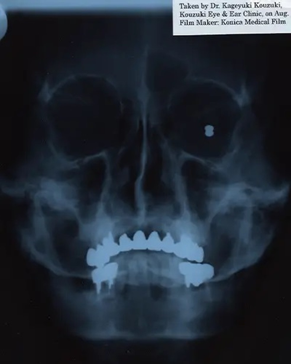 Radiografia do crânio de Satoru tirada em 2001 — Foto: Guinness World Records