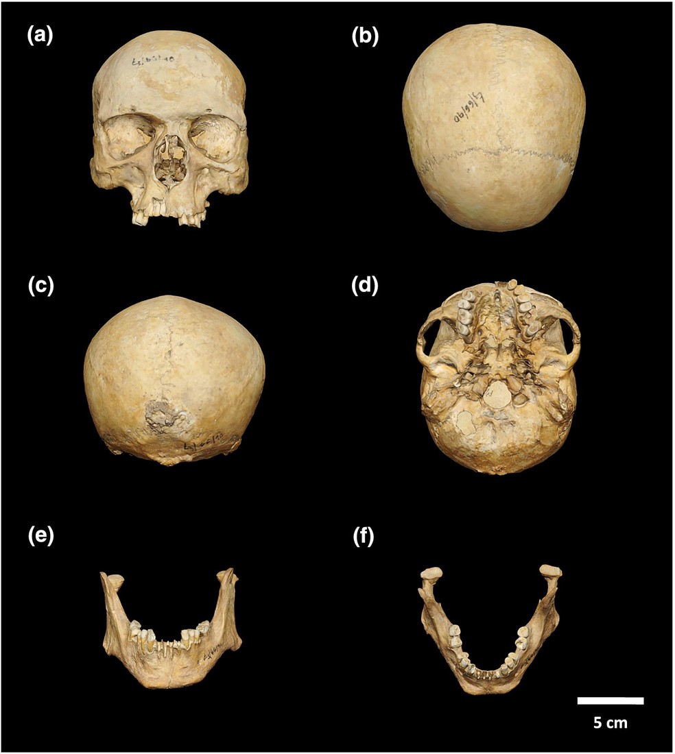 Crânio do homem medieval que viveu durante os séculos 9 a 11 d.C. — Foto: Madalena D. Matczak et.al 