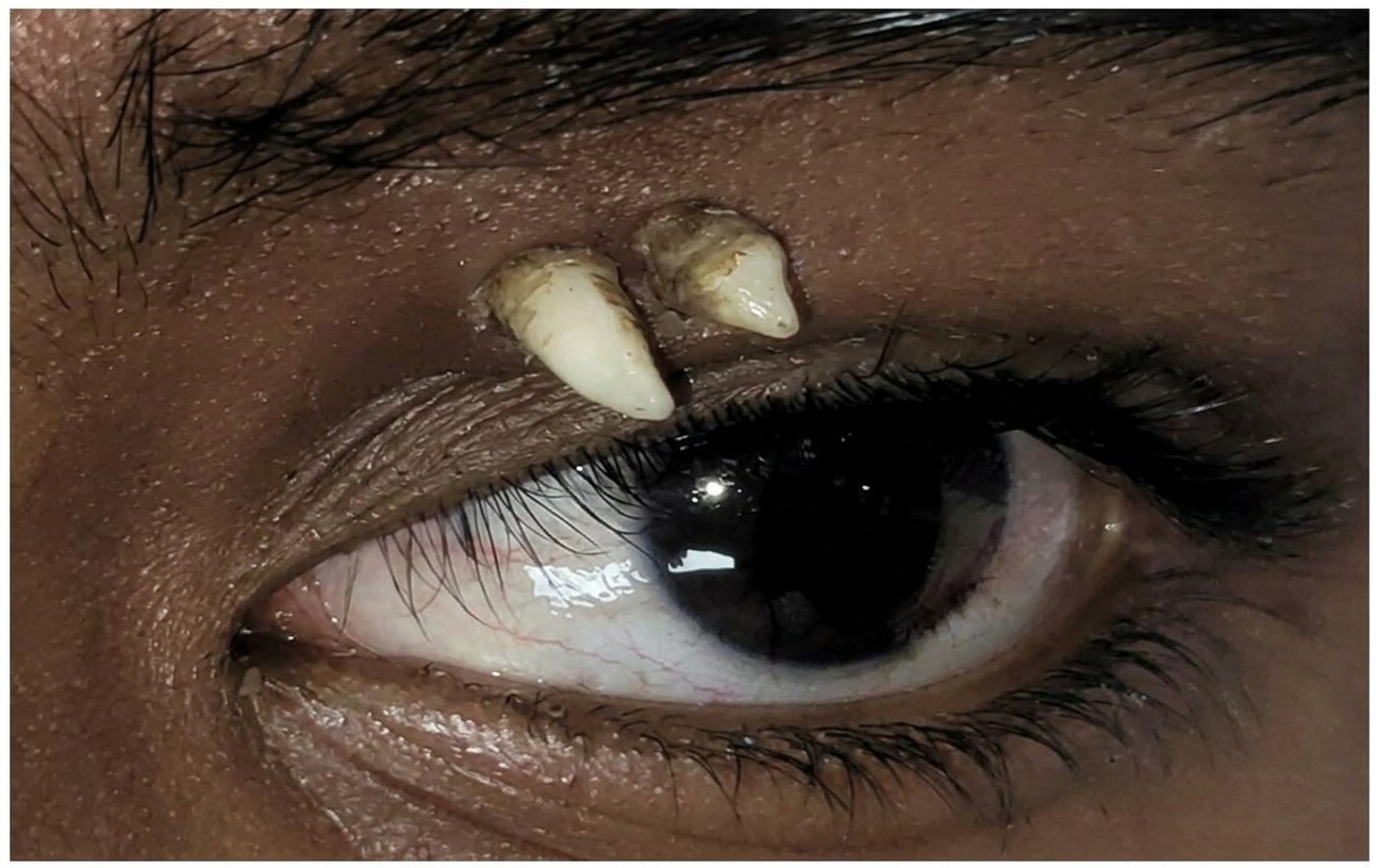 Dente cresce entre olho e sobrancelha de adolescente de 16 anos; entenda