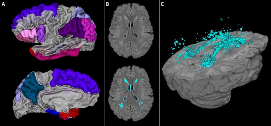 Imagens cerebrais em 3D do novo estudo mostram regiões do cérebro onde a substância branca foi danificada.