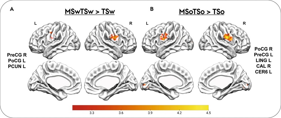 Imagem do estudo revela a mudança na percepção de sabor (área alaranjada) no cérebro quando os participantes comiam com (lado direito) e sem (lado direito) música — Foto: Seeberg et al/Scientific Reports/Reprodução